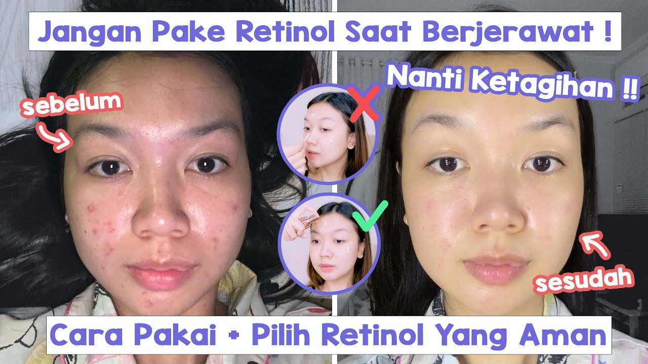 Retinol Bekerja Maksimal