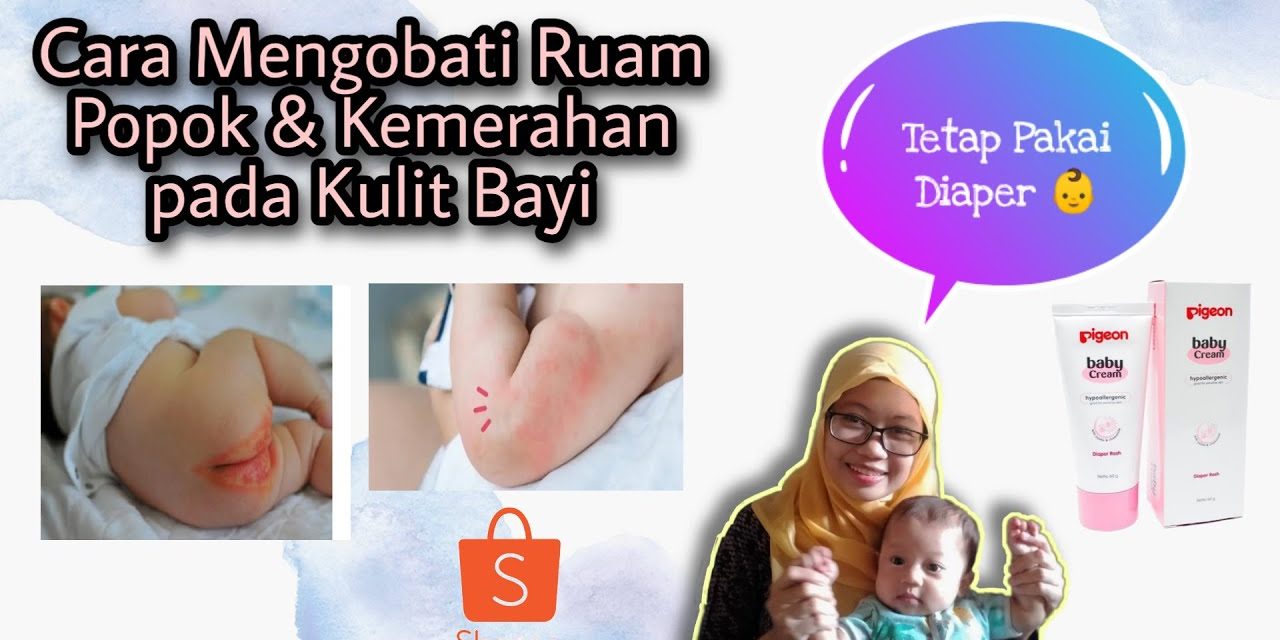 Ruam Popok Pada Bayi, Ini Cara Pelindung Agar Tidak Iritasi