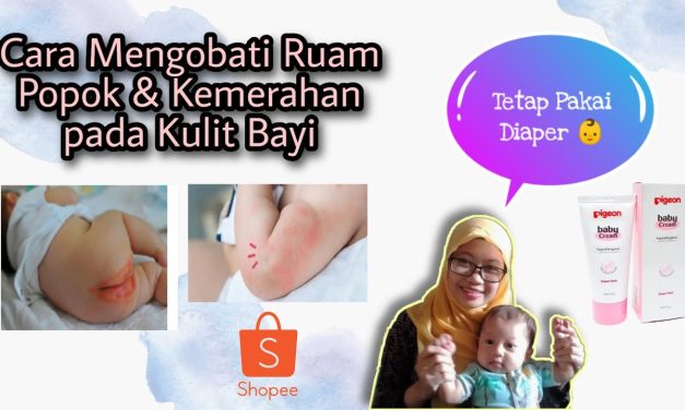 Ruam Popok Pada Bayi, Ini Cara Pelindung Agar Tidak Iritasi