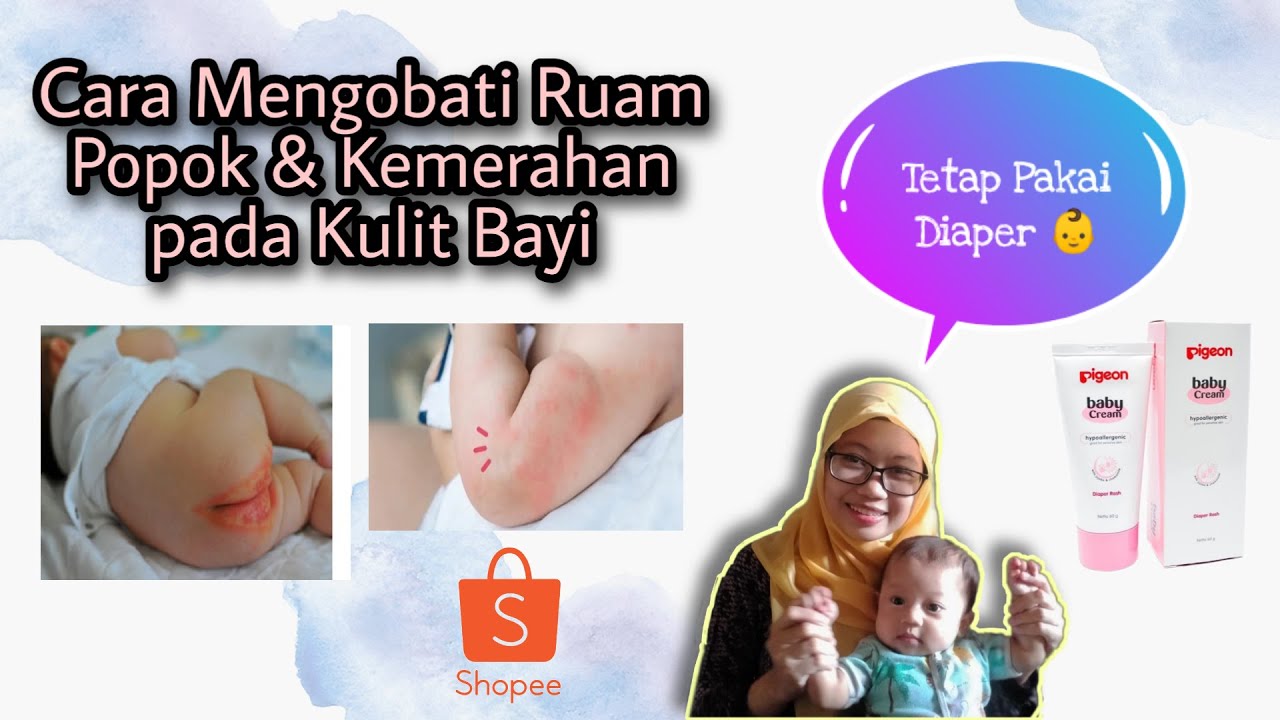 Ruam Popok Pada Bayi
