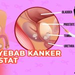 Penyakit Kanker Prostat Berkembang Di Kelenjar Prostat